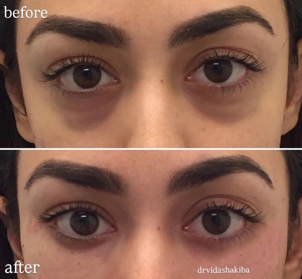 At عيادة الدكتورة فيدا شكيبة (الزعفرانية والصادقية، طهران)، يتم توفير مجموعة متنوعة من خدمات التجميل مثل حقن الجل، البوتوكس، شد الخيوط وغيرها، وحقن الجل تحت العين هي إحدى هذه الخدمات