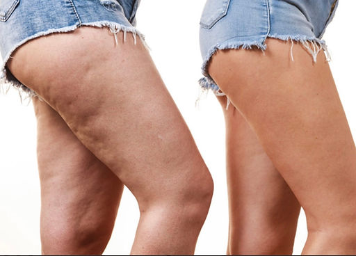 بهترین درمان سلولیت و رفع لاغری پوست پرتقال و رفع سلولیت و لاغری پوست هم زمان با دکتر ویدا شکیبا